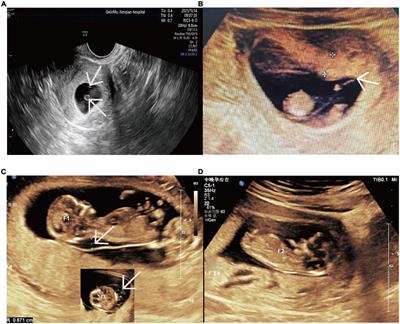 Twins measuring small 2024 for gestational age